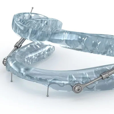 Clear oral appliance used for sleep apnea treatment