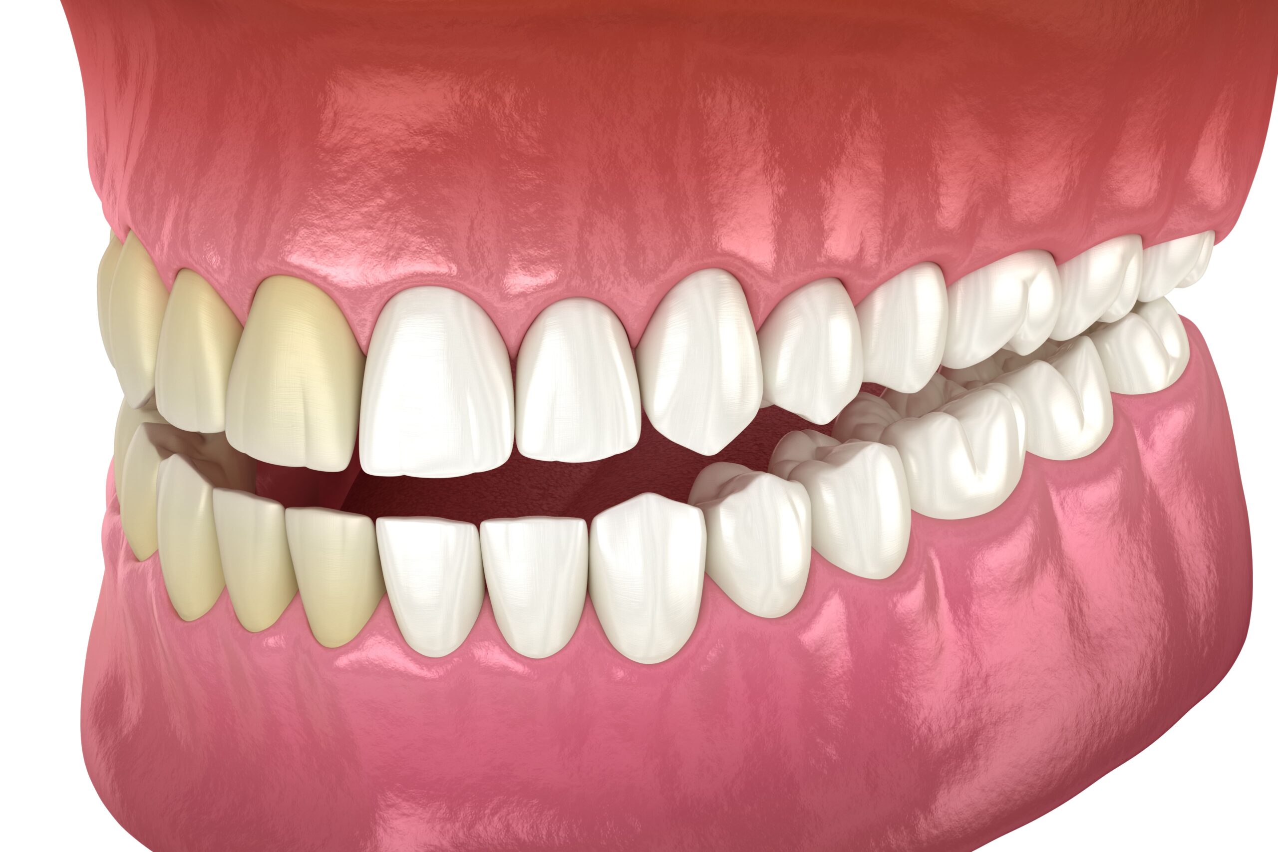 3D illustration showing teeth whitening treatment results