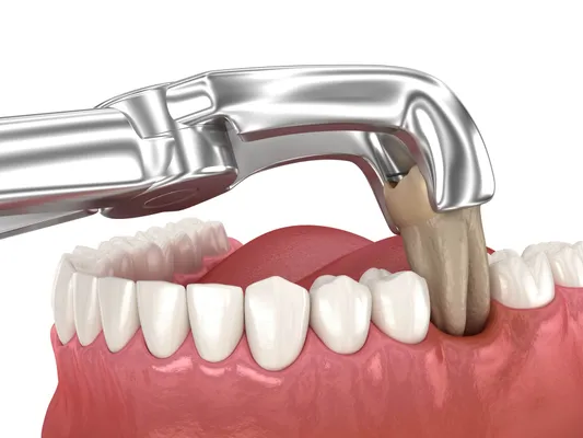 3D illustration of a tooth extraction being performed with dental instruments
