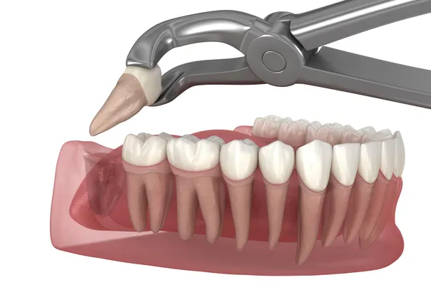 3D illustration of a wisdom tooth extraction procedure using dental forceps