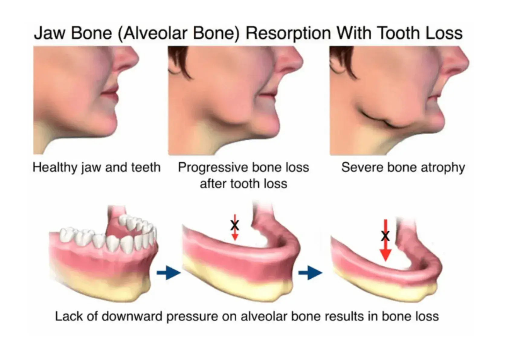 Jaw bone resorption stages showing healthy teeth, progressive bone loss, and severe bone atrophy from missing teeth.