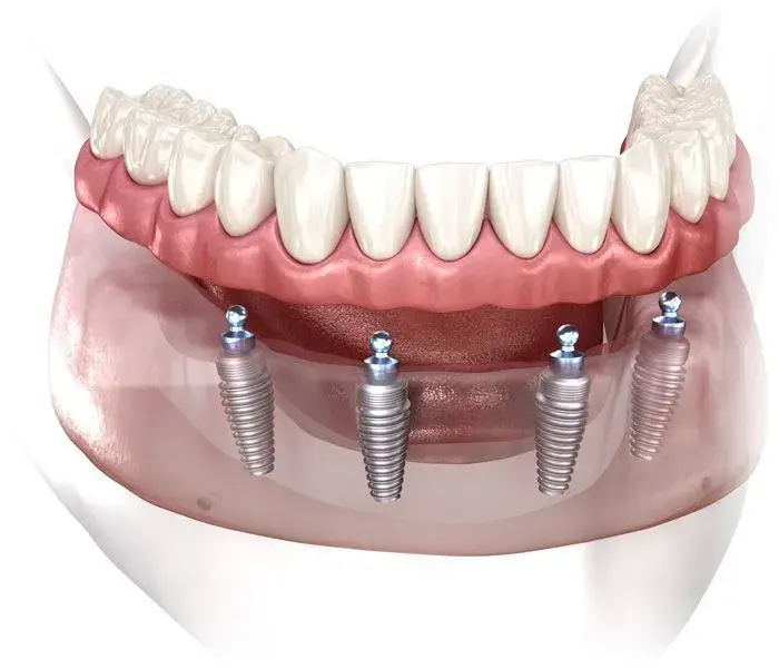 All-on-4 dental implants diagram showing four titanium implants supporting a full arch of replacement teeth.