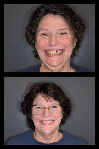 Before and after dental treatment results for a patient at Joshua M. Ignatowicz DMD & Associates