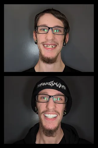 Before and after dental treatment results for a patient at Joshua M. Ignatowicz DMD & Associates