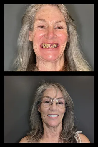 Before and after dental treatment results for a patient at Joshua M. Ignatowicz DMD & Associates