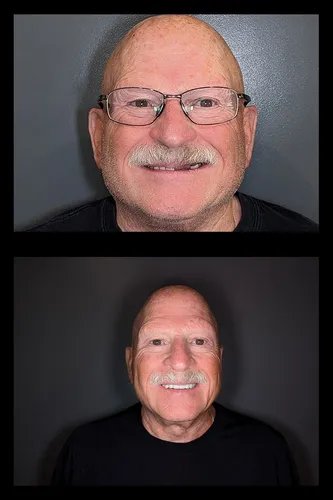 Before and after dental treatment results for a patient at Joshua M. Ignatowicz DMD & Associates