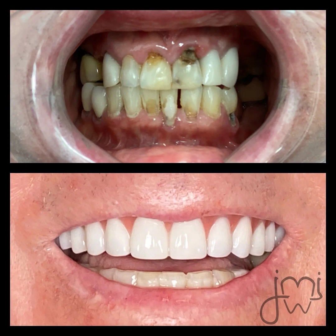 Before and after dental treatment results for a patient at Joshua M. Ignatowicz DMD & Associates