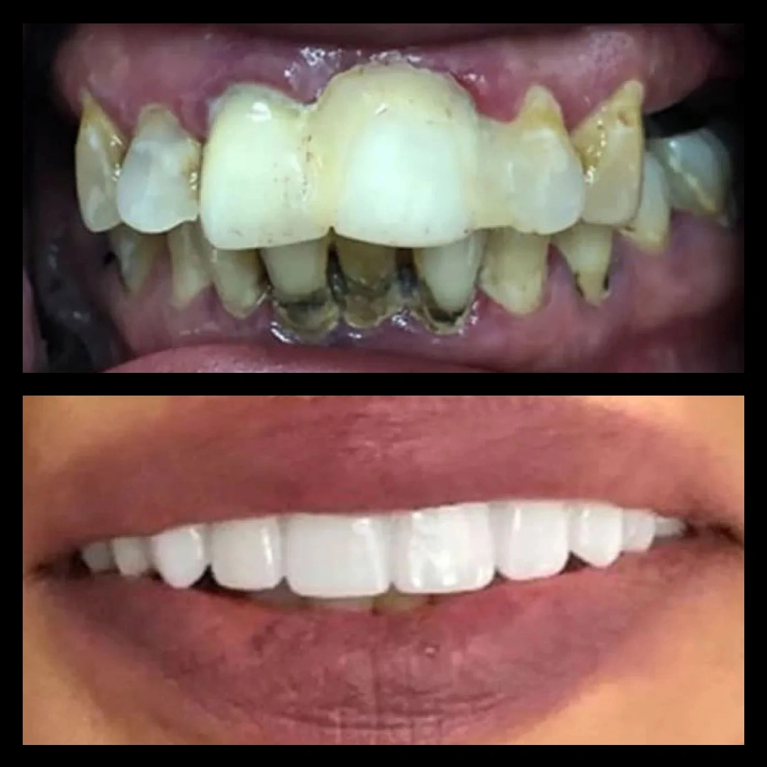 Before and after dental treatment results for a patient at Joshua M. Ignatowicz DMD & Associates