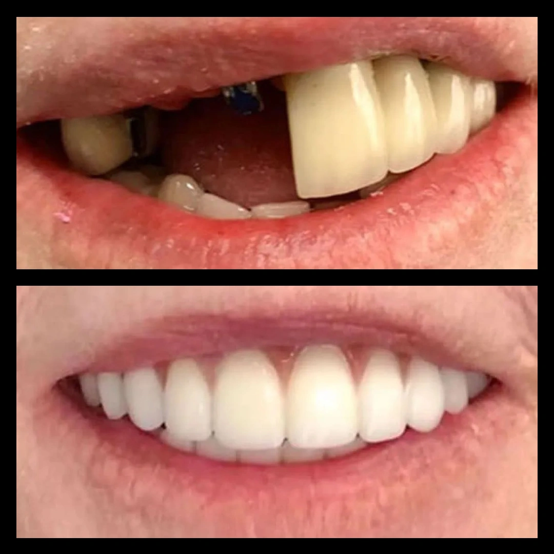 Before and after dental treatment results for a patient at Joshua M. Ignatowicz DMD & Associates