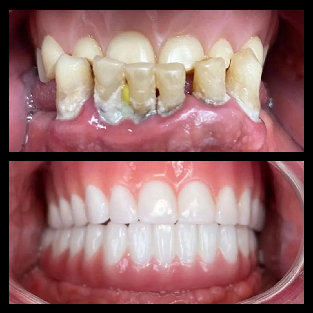 Before and after dental treatment results for a patient at Joshua M. Ignatowicz DMD & Associates