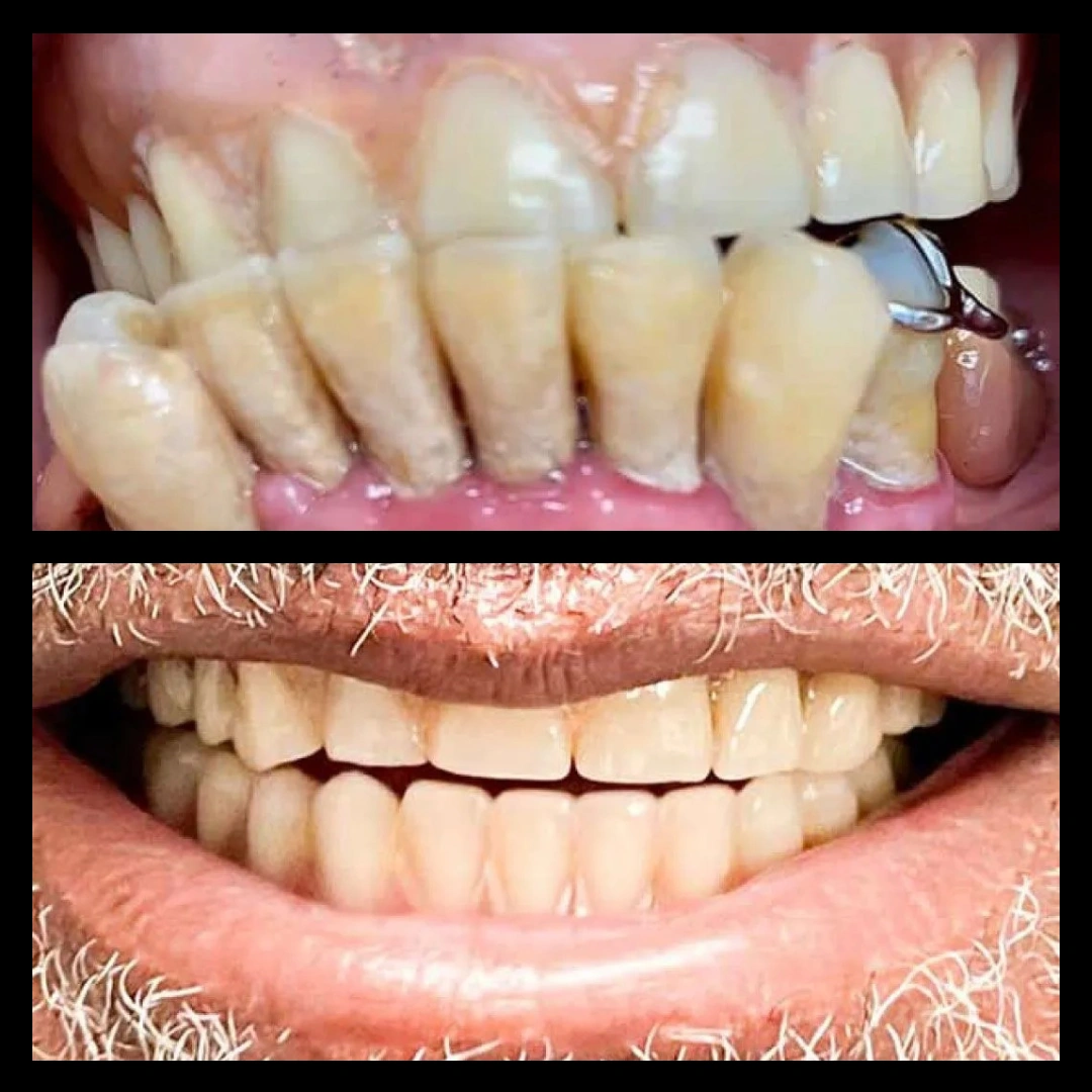 Before and after dental treatment results for a patient at Joshua M. Ignatowicz DMD & Associates