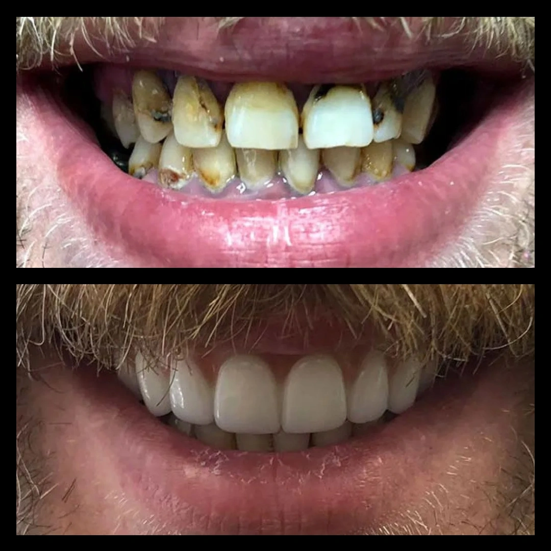 Before and after dental treatment results for a patient at Joshua M. Ignatowicz DMD & Associates