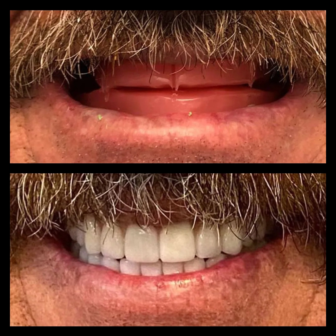 Before and after dental treatment results for a patient at Joshua M. Ignatowicz DMD & Associates