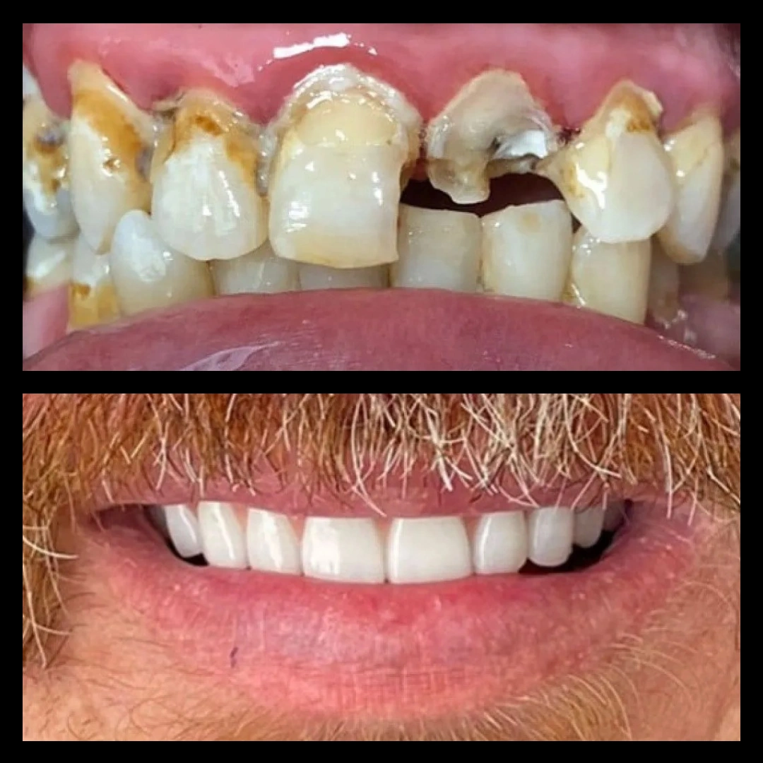 Before and after dental treatment results for a patient at Joshua M. Ignatowicz DMD & Associates