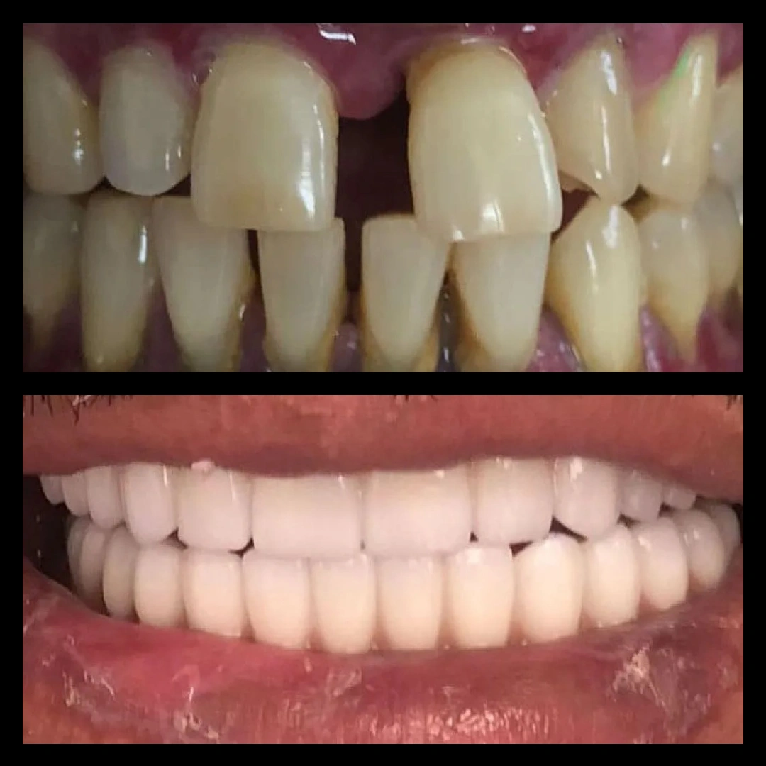 Before and after dental treatment results for a patient at Joshua M. Ignatowicz DMD & Associates