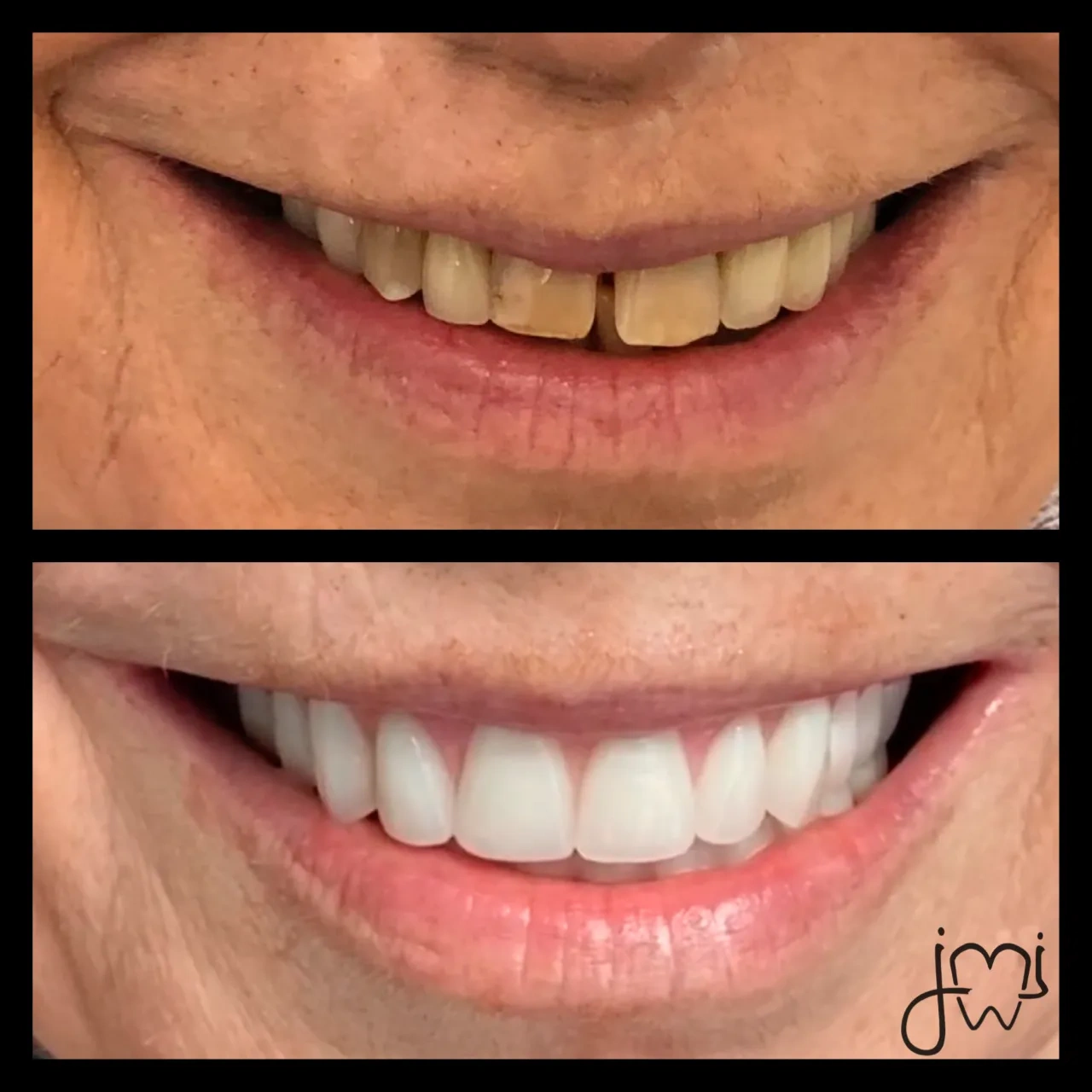Before and after dental treatment results for a patient at Joshua M. Ignatowicz DMD & Associates