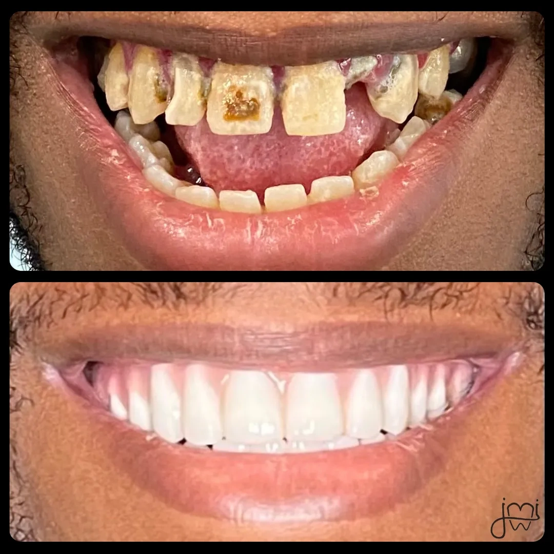 Before and after dental treatment results for a patient at Joshua M. Ignatowicz DMD & Associates