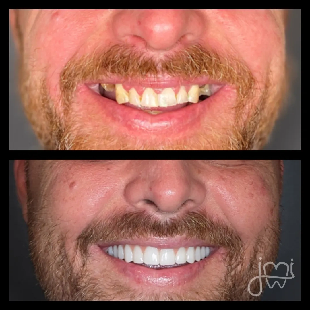Before and after dental treatment results for a patient at Joshua M. Ignatowicz DMD & Associates