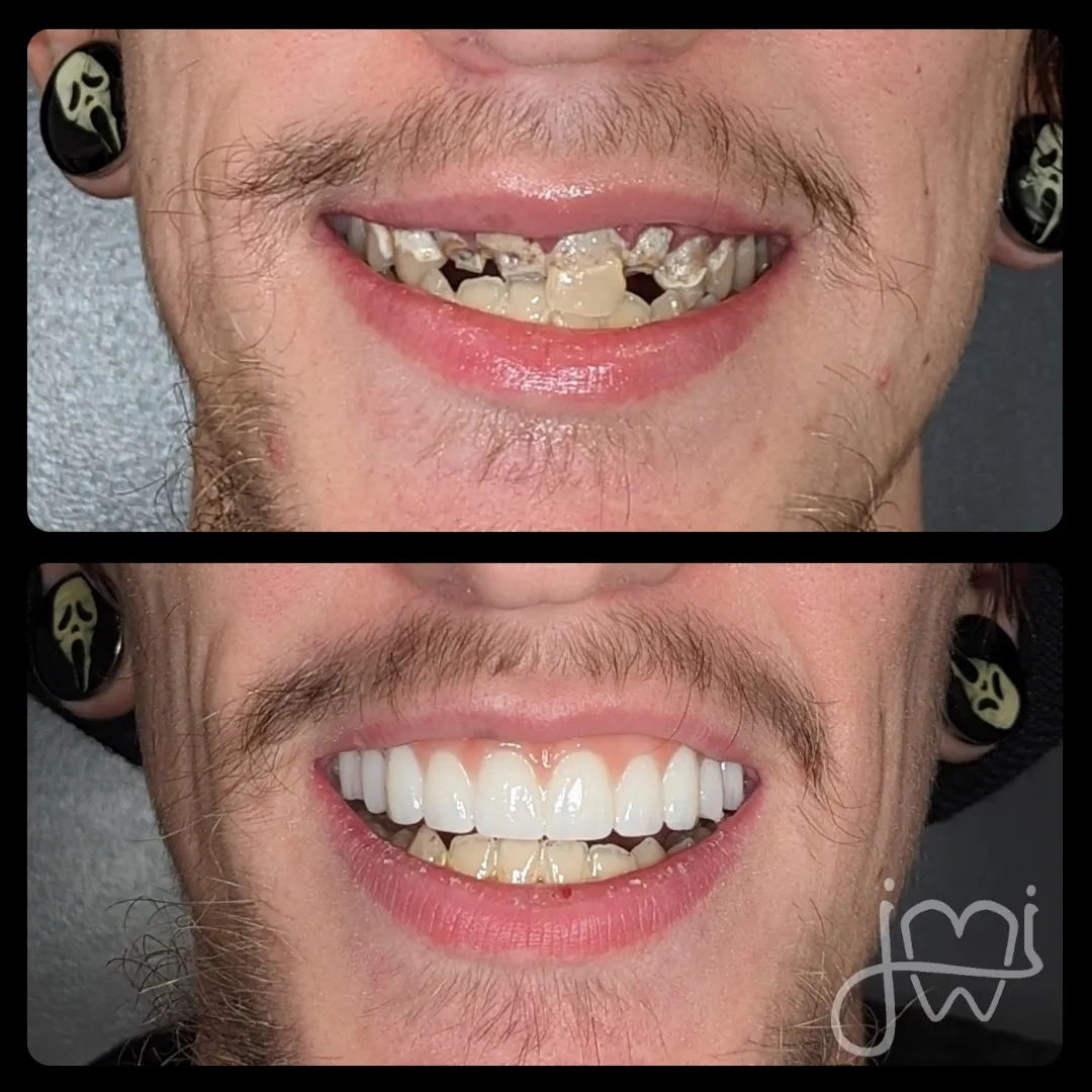 Before and after dental treatment results for a patient at Joshua M. Ignatowicz DMD & Associates