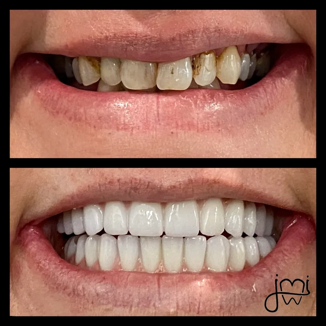 Before and after dental treatment results for a patient at Joshua M. Ignatowicz DMD & Associates