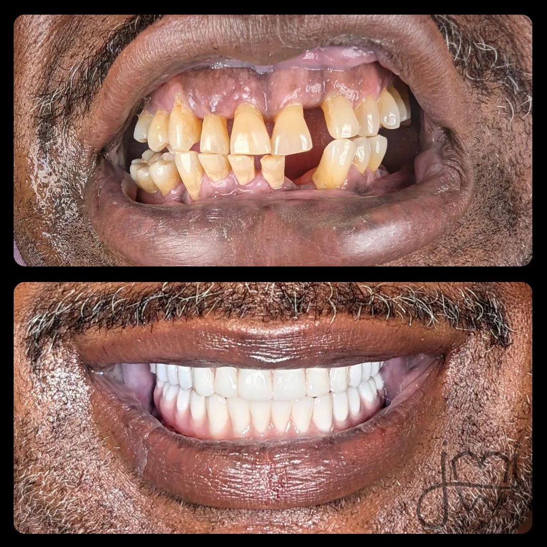 Before and after dental treatment results for a patient at Joshua M. Ignatowicz DMD & Associates