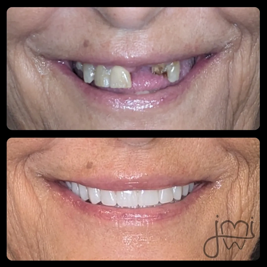 Before and after dental treatment results for a patient at Joshua M. Ignatowicz DMD & Associates
