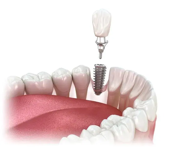 Dental implant illustration showing screw placement between natural teeth in Henderson, NV.