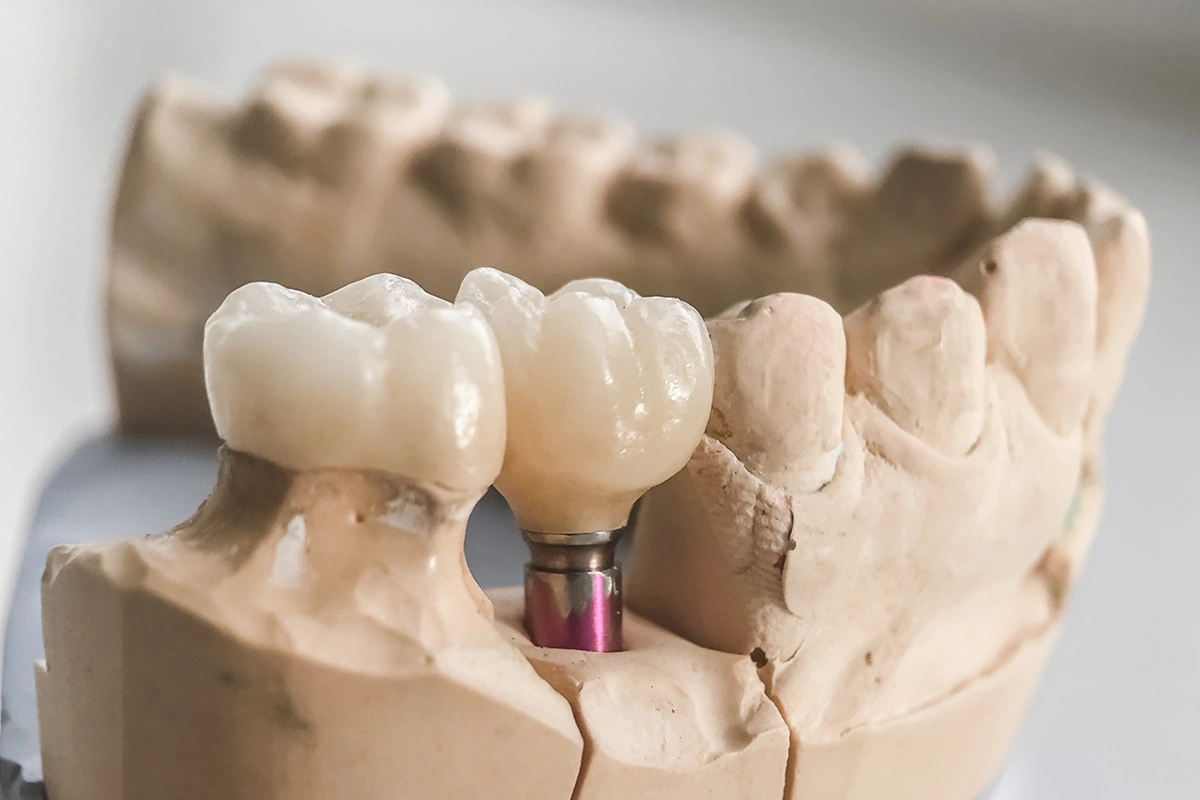 is-it-important-to-get-an-implant-on-a-back-tooth