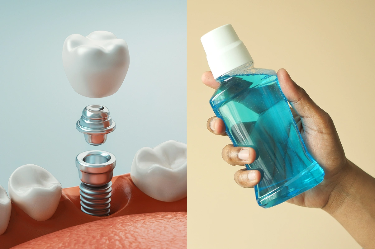 is-mouthwash-safe-to-use-with-dental-implants