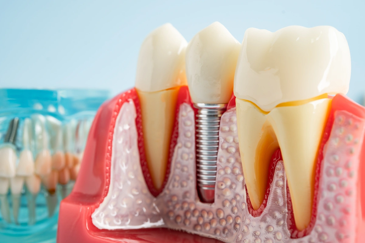 why-dental-implants-are-americas-top-choice-in-2024