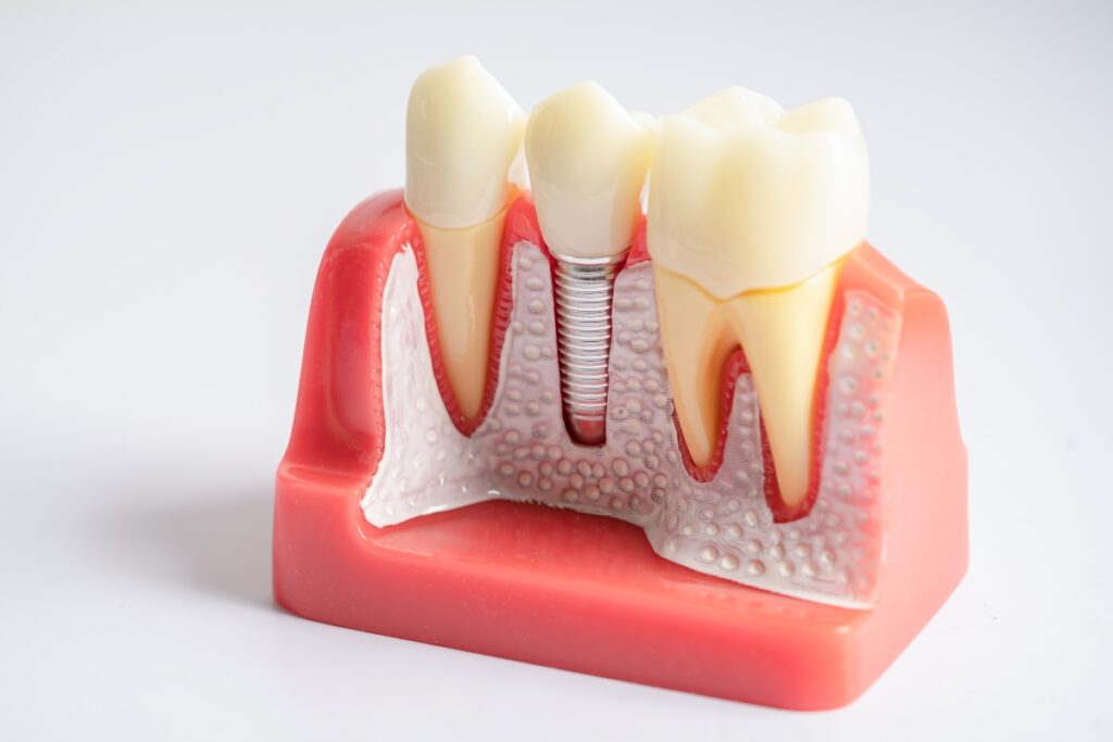 dental implants