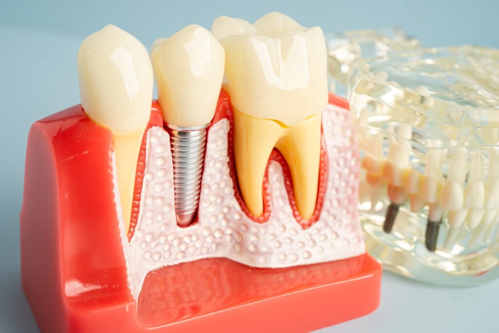 Bone Graft to Be Ready for a Dental Implant