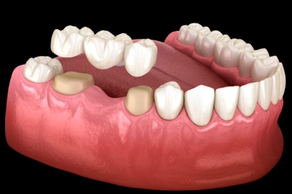 Dental Bridges in Henderson
